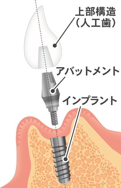 インプラントの構造